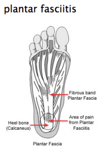 plantar-fasciitis-treatment-vancouver