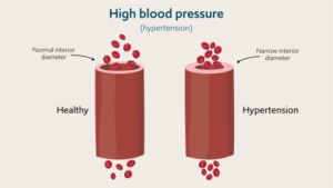 234 RBHH Illustrations Apr 23 Hypertension v1